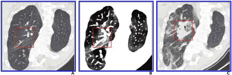 Spectral CT improves detection of early-stage coronavirus disease (COVID-19)