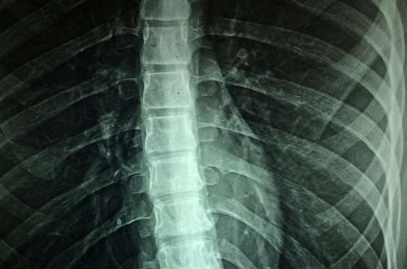 spinal x-ray