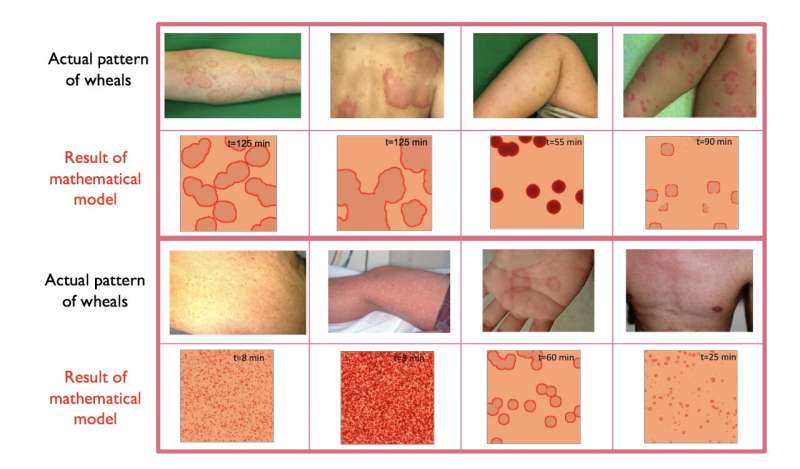 Studying the geometry of a common skin disease