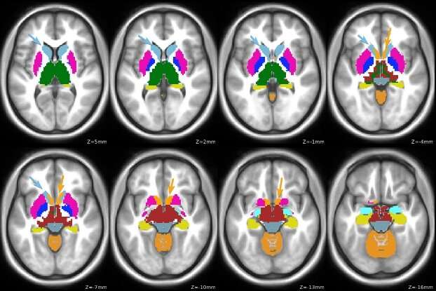 Study links brain function changes to genetic risk in attention deficit/hyperactivity disorder diagnosis