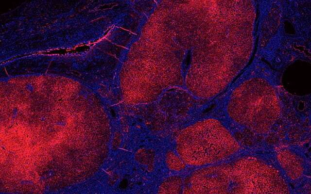 Study: Two enzymes control liver damage in NASH