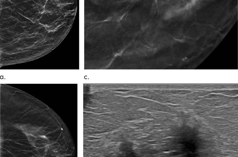 在一项为期五年的研究中，断层成像优于数字乳房x线照相术