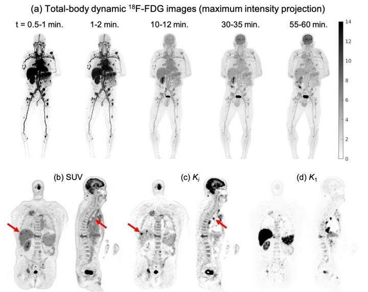 Total-body dynamic PET successfully detects metastatic cancer; first patient results