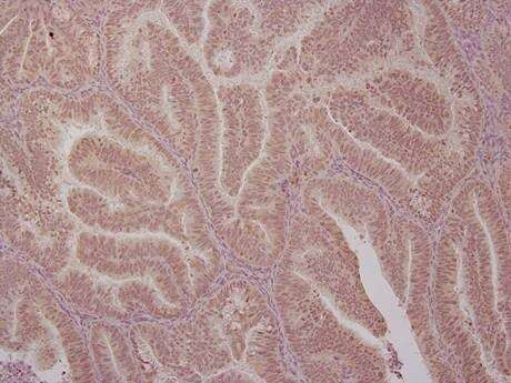 犹他州研究人员发现子宫内膜癌生长的关键蛋白质