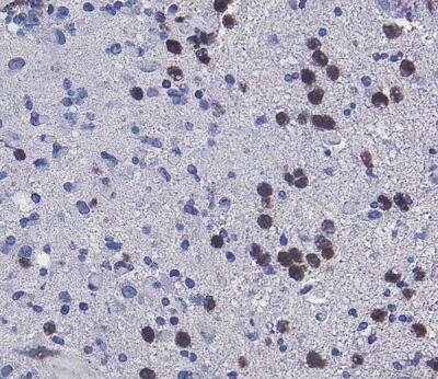 White blood cells may cause tumor cell death -- but that's not good news