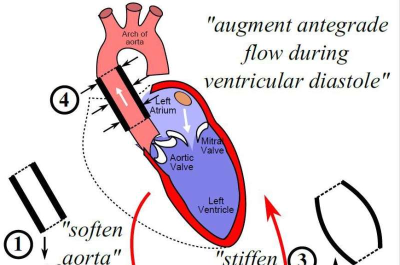 Artificial aorta can reduce patients' blood pressure