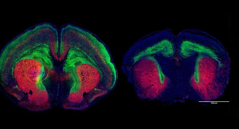 Autism gene study finds widespread impact to brain's growth signaling network