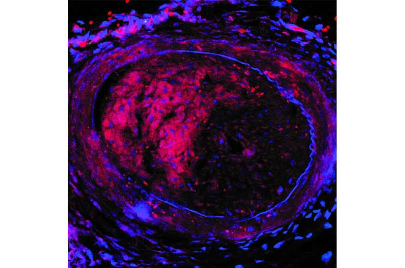 Cell-selective nanotherapy prevents post-angioplasty restenosis, promotes artery healing
