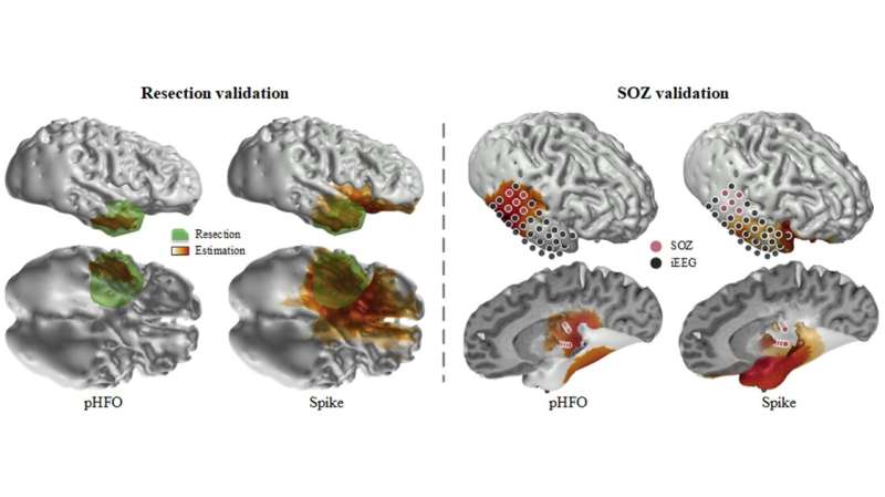 Fast brainwave oscillations identify and localize epileptic brain