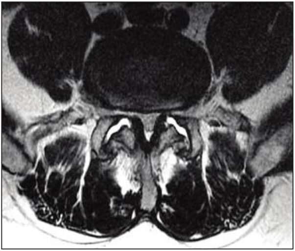 Impact of patient-reported symptom information on lumbar spine MRI Interpretation
