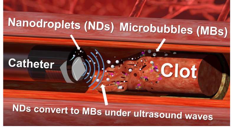Nanodroplets and ultrasound 'drills' prove effective at tackling tough blood clots