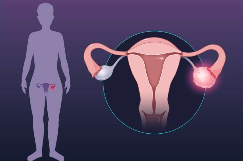 NICE批准卵巢癌新的维持治疗