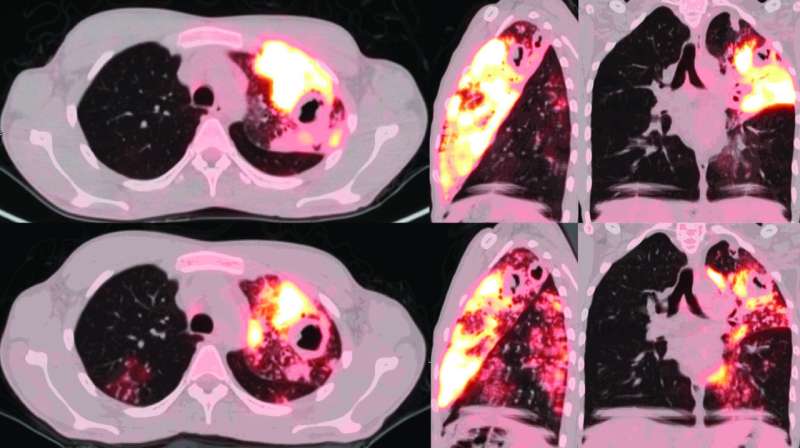PET and CT scans provide keen views of lungs with active TB, and are better assessment tools than sputum tests