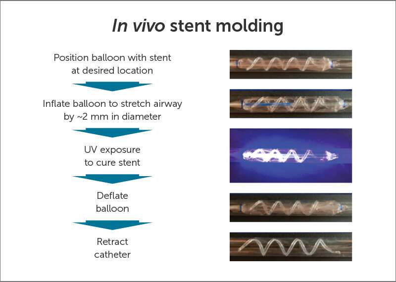 Soft stents, hardened in place by UV light, allow a snug, custom fit