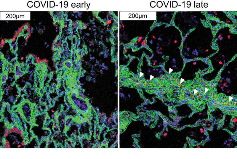 New technique provides detailed map of lung pathology in COVID-19