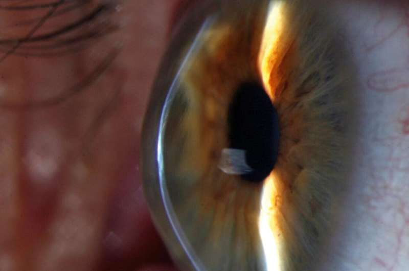 Genetic study uncovers hidden pieces of?eye disease?puzzle?