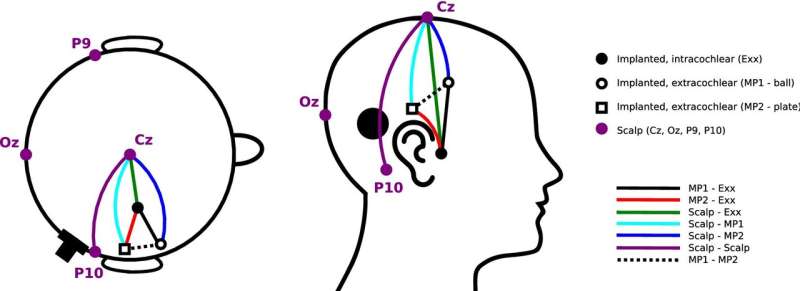 Experimental hearing implant succeeds in registering brain waves
