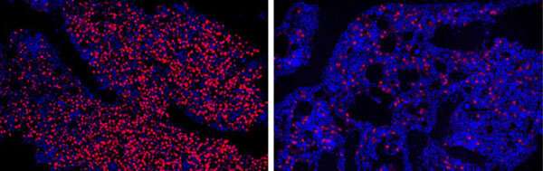 Designer DNA therapeutic wipes out cancer stem cells, treats multiple myeloma in mice