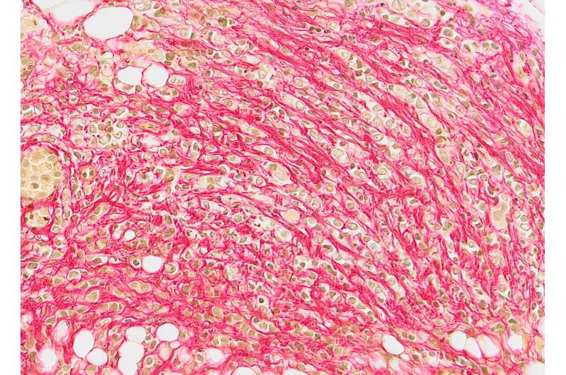 科学家模拟了一种特殊类型的乳腺癌