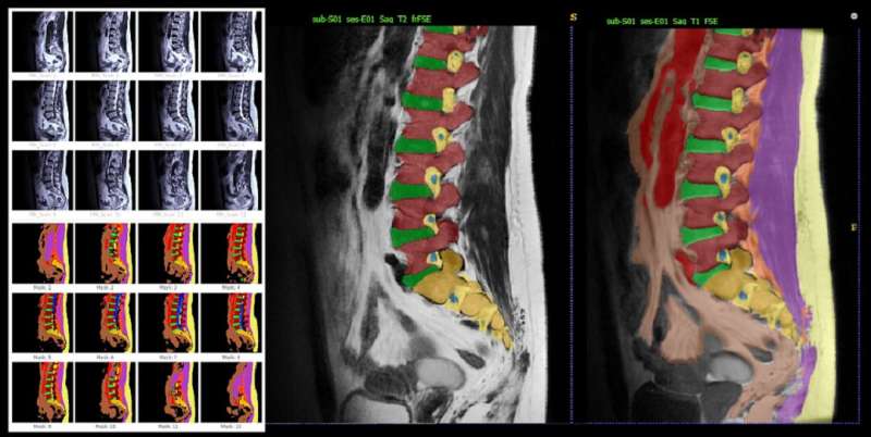 Improving the interpretation of spinal cord magnetic resonance images