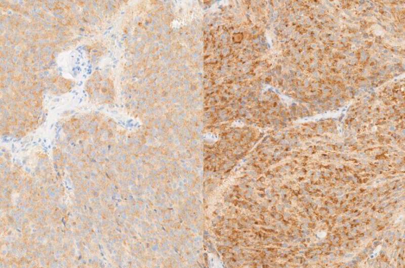 Abundance of iron drives cell death and could inform novel treatments for neuroblastoma