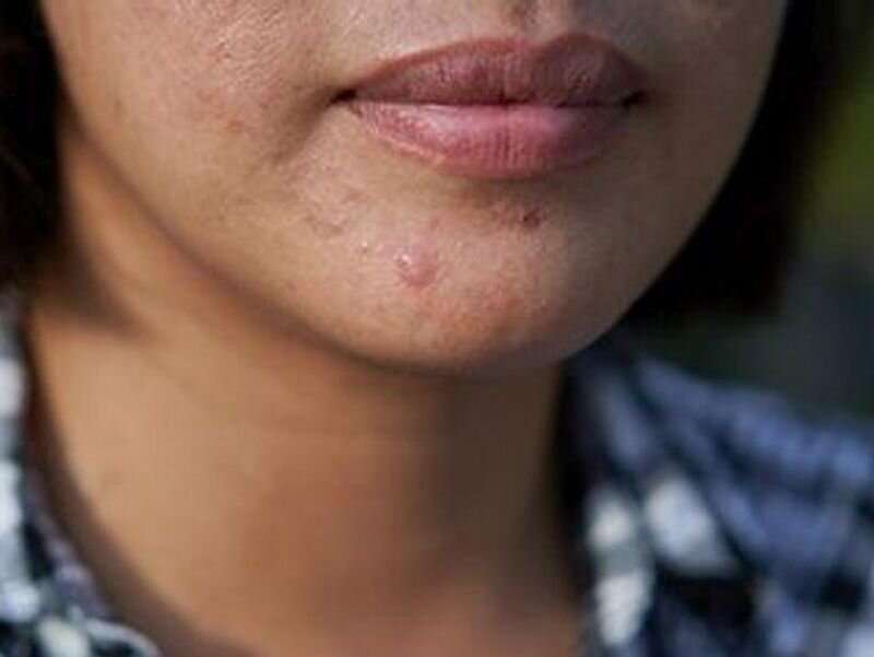 Acne negatively impacts emotional health of adult women