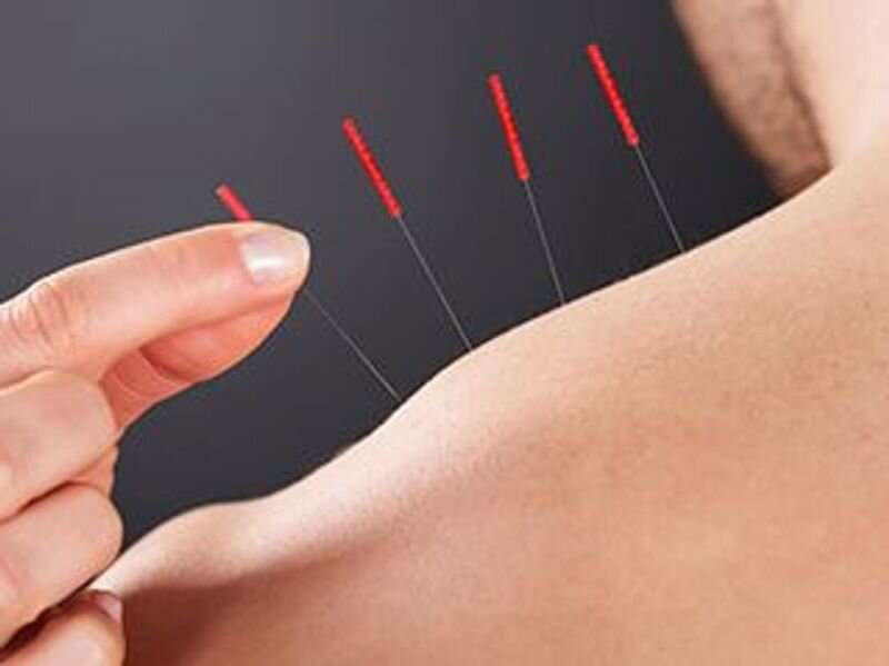 Acupuncture effective for chronic muscular pain in cancer survivors