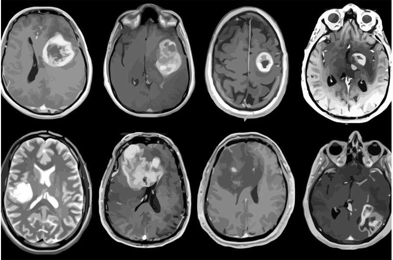 Aggressive brain tumor mapped in genetic, molecular detail