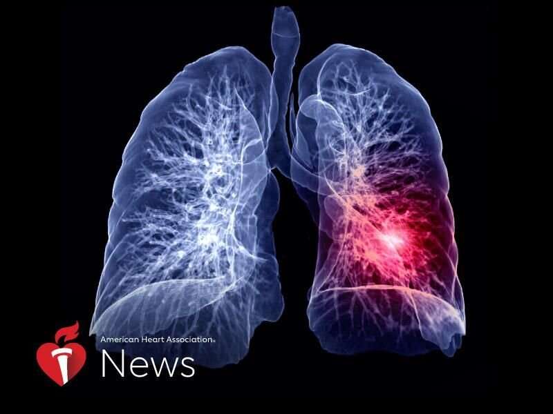 AHA news: pulmonary embolism is common and can be deadly, but few know the signs