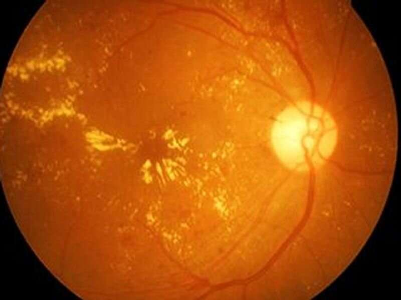 AHA issues statement on central retinal artery occlusion