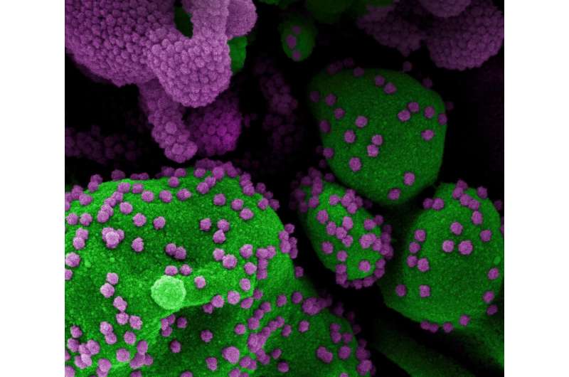 A human cell (green) infected with coronavirus particles (purple)
