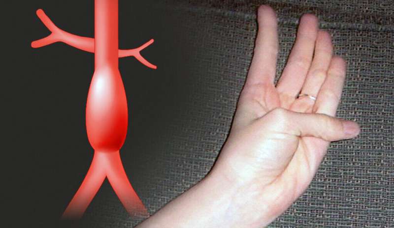 All in favor of a test for aortic aneurysms, raise your hand