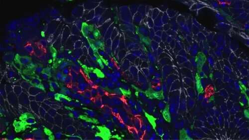 一项新的研究将白细胞介素11鉴定为癌症相关成纤维细胞的标志物