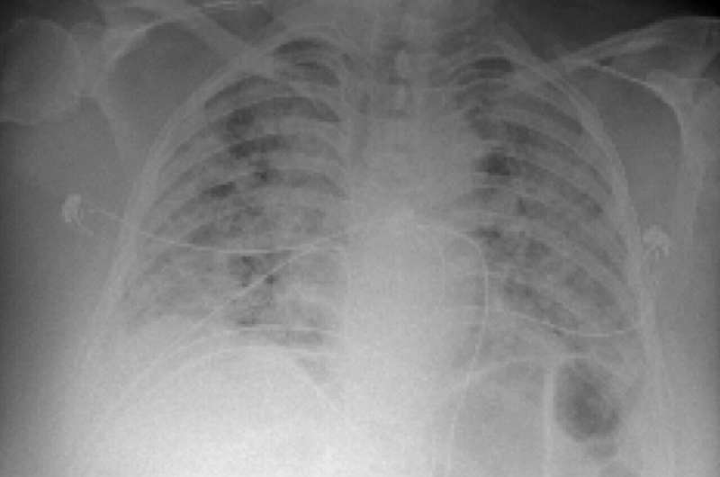 Artificial intelligence tool uses chest X-ray to differentiate worst cases of COVID-19