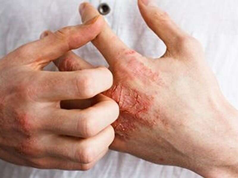Baricitinib shows long-term efficacy for atopic dermatitis