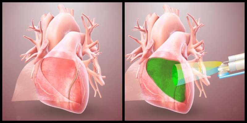 Bio-inspired hydrogel protects the heart from post-op adhesions