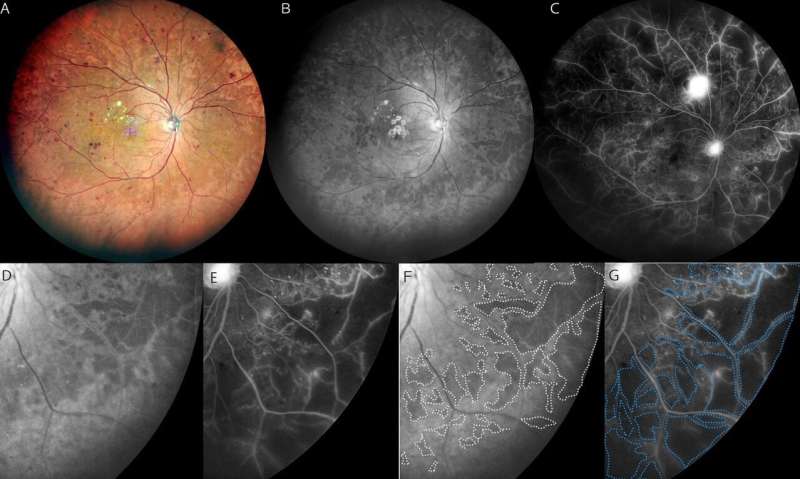 Blue is the clue to evaluating diabetic retinopathy