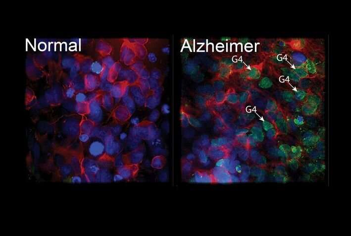 BMI1, a promising gene to protect against Alzheimer's disease