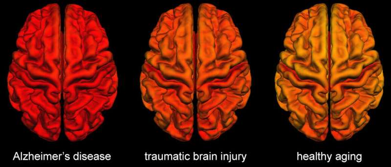 Brain changes following traumatic brain injury share similarities with Alzheimer's disease