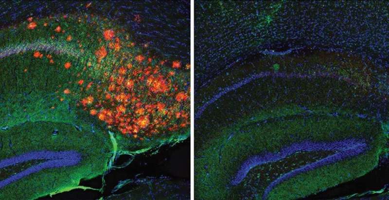 Brain cholesterol regulates Alzheimer's plaques, study reveals