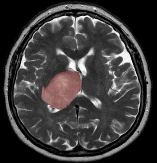 Brain cancer linked to tissue healing