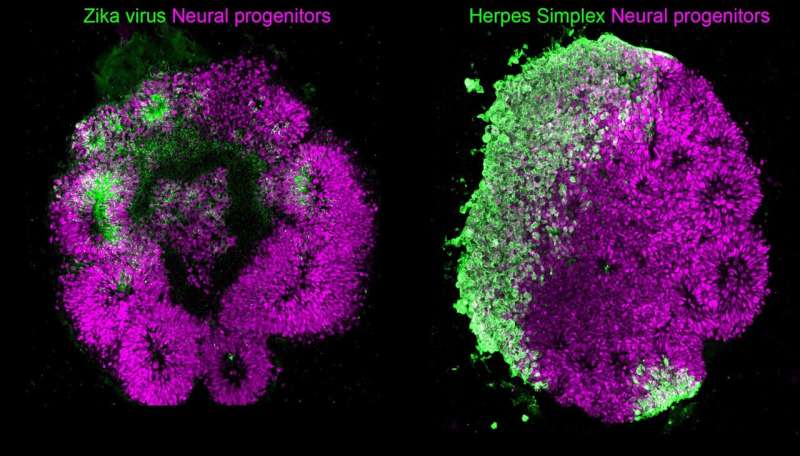 Brain organoids uncover various mechanisms of virus-induced microcephaly