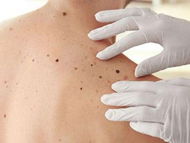 Certain dermoscopic structures linked to melanoma detection