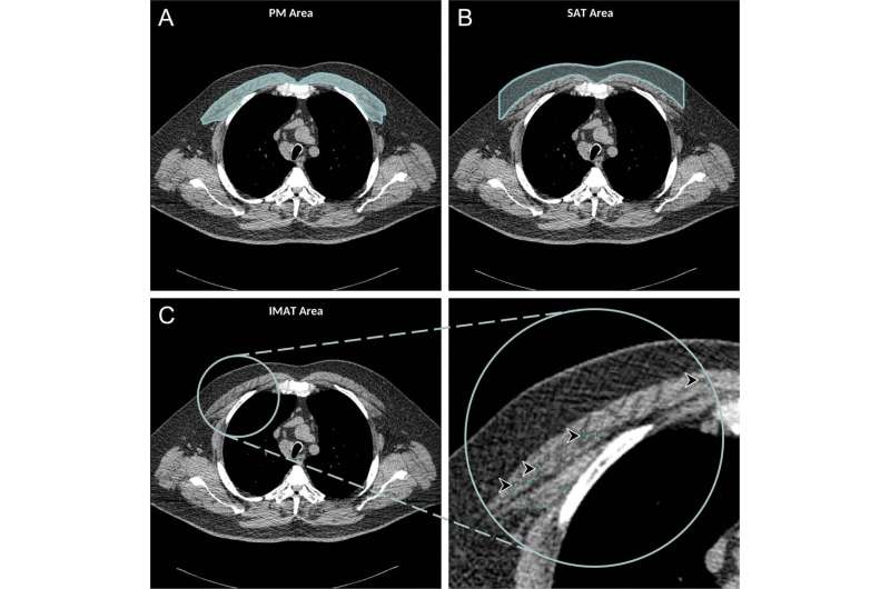Chest CT illuminates mortality risk in people with COPD