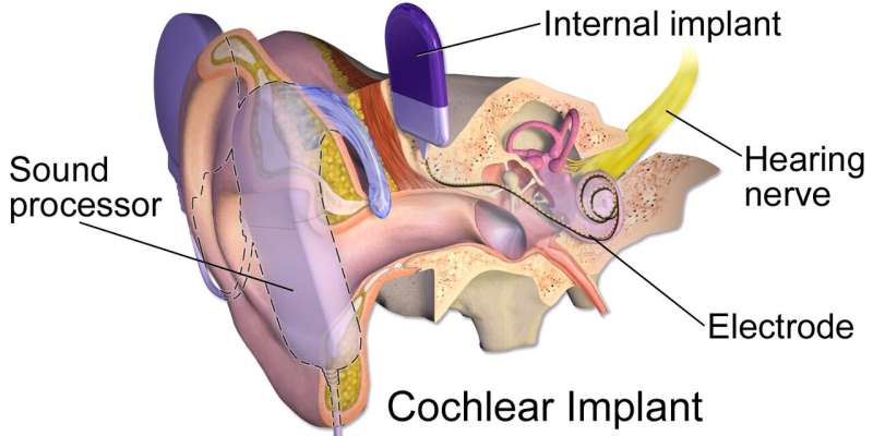 Cochlear implant in deaf children with autism can improve language skills and social engagement