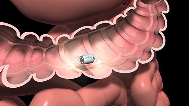 Colon capsule endoscopy – reshaping bowel cancer diagnosis