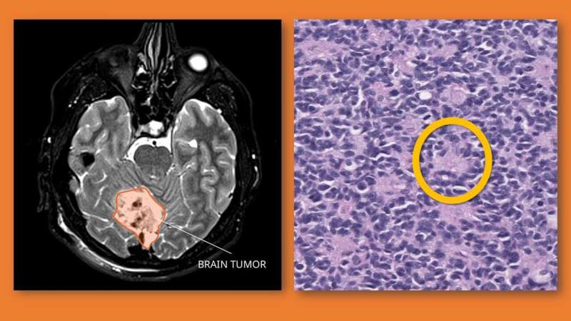 Combining two 'old therapies' packs a powerful punch against pediatric brain tumors