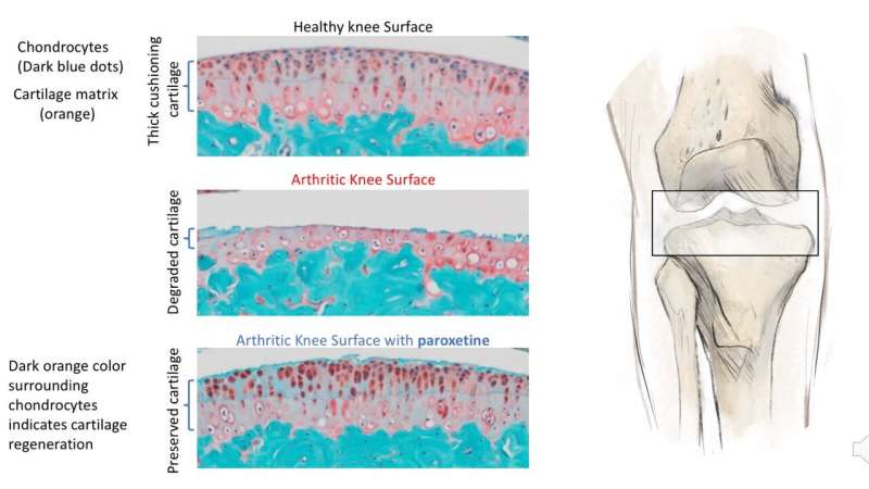Common anti-depressant may be first-ever treatment for osteoarthritis