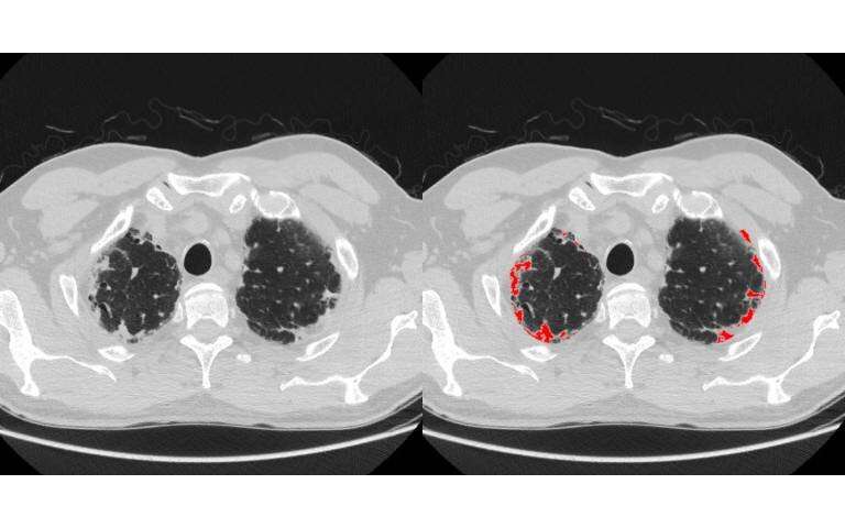 Computerised image analysis identifies new subtype of debilitating lung disease