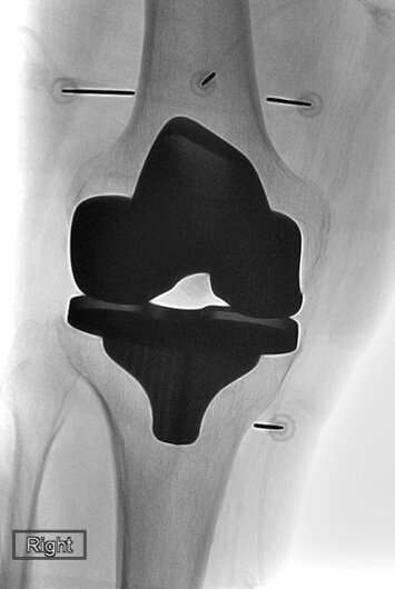 Cooled RFA relieves pain after knee replacement
